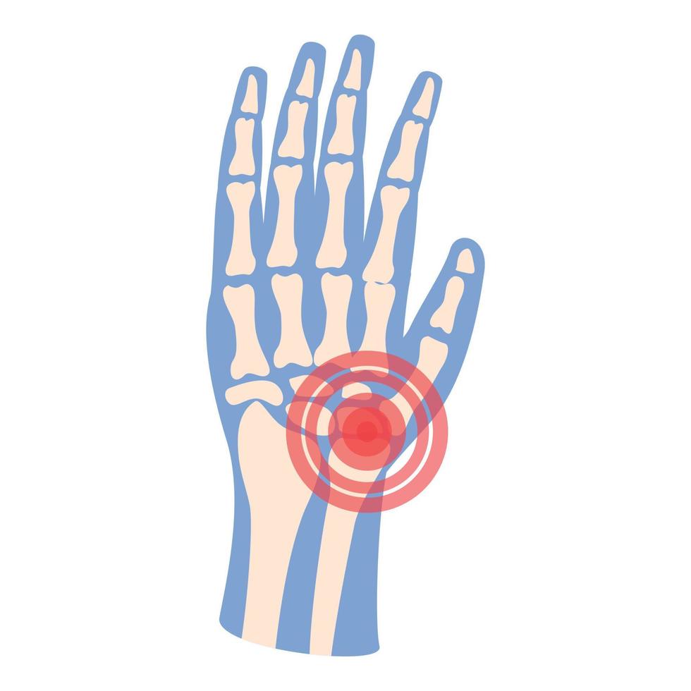 handarthritis symbol cartoon vektor. Gelenkschmerzen vektor