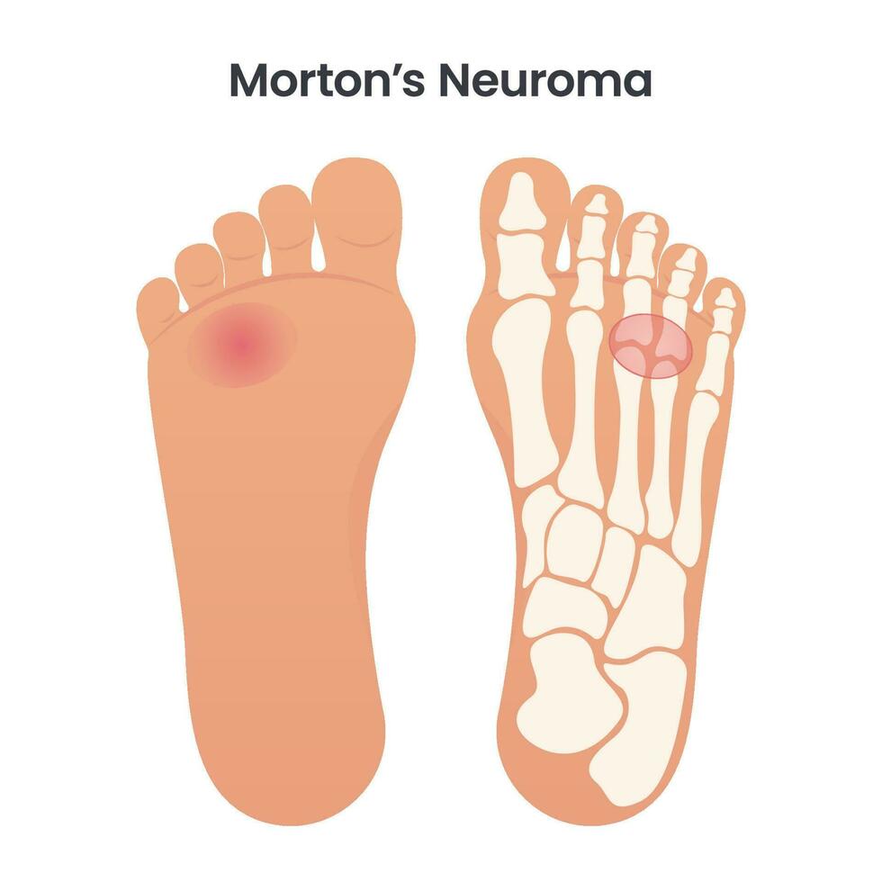 Mortons Neurom medizinische pädagogische Vektorgrafik-Grafik vektor