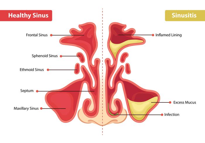 Hälsosam sinus och bihåleinflammation vektor