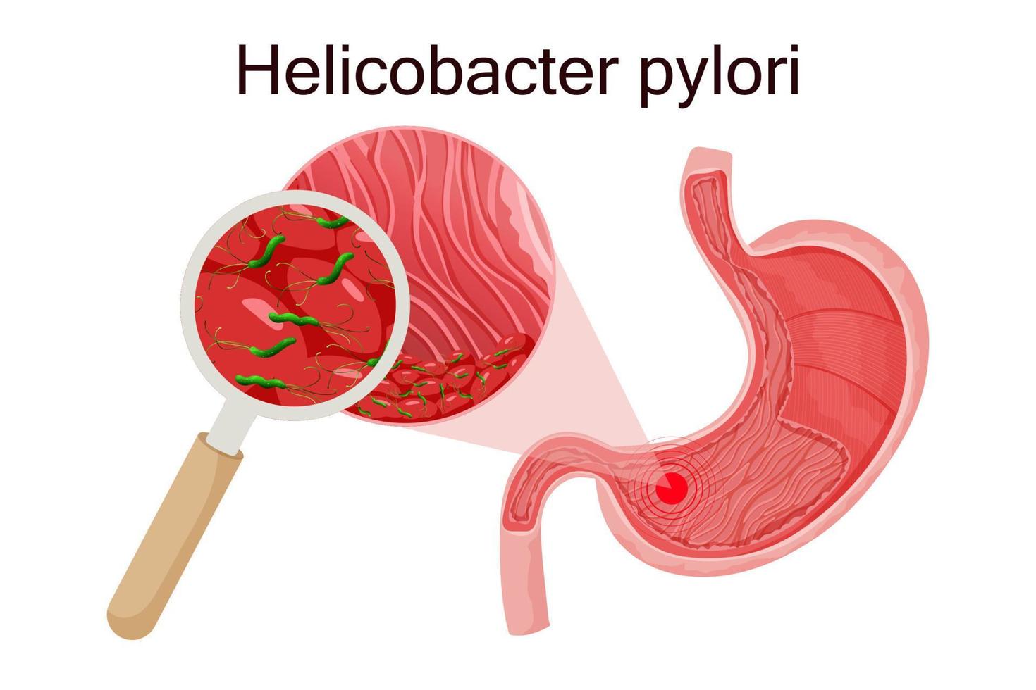 Gastritis verursacht durch Helicobacter pylori im Magen unter Lupe. detaillierte vektorabbildung vektor