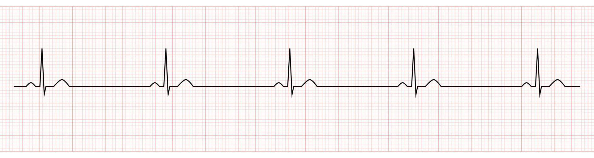 ekg som visar sinus bradykardi av patient vektor