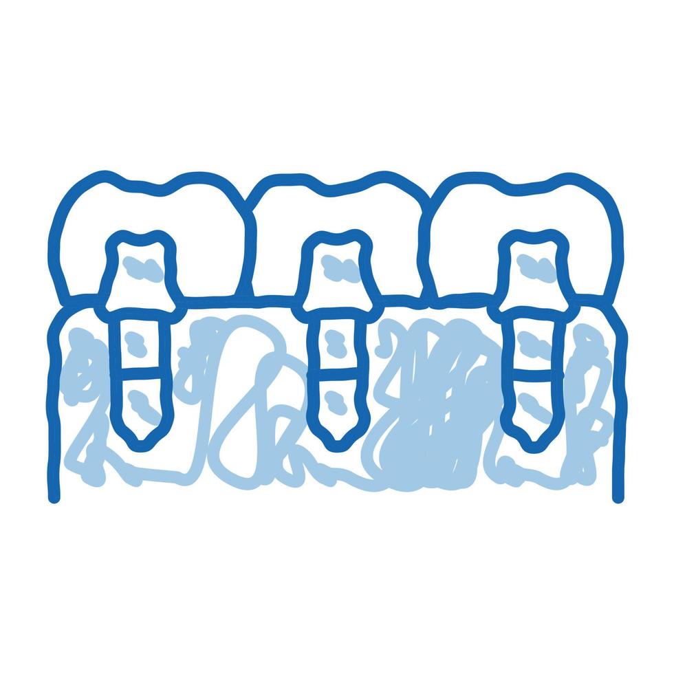 dental tänder implantat biomaterial klotter ikon hand dragen illustration vektor