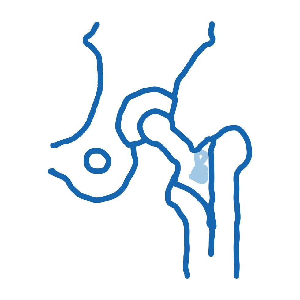 höft implantera ersättning biomaterial klotter ikon hand dragen illustration vektor