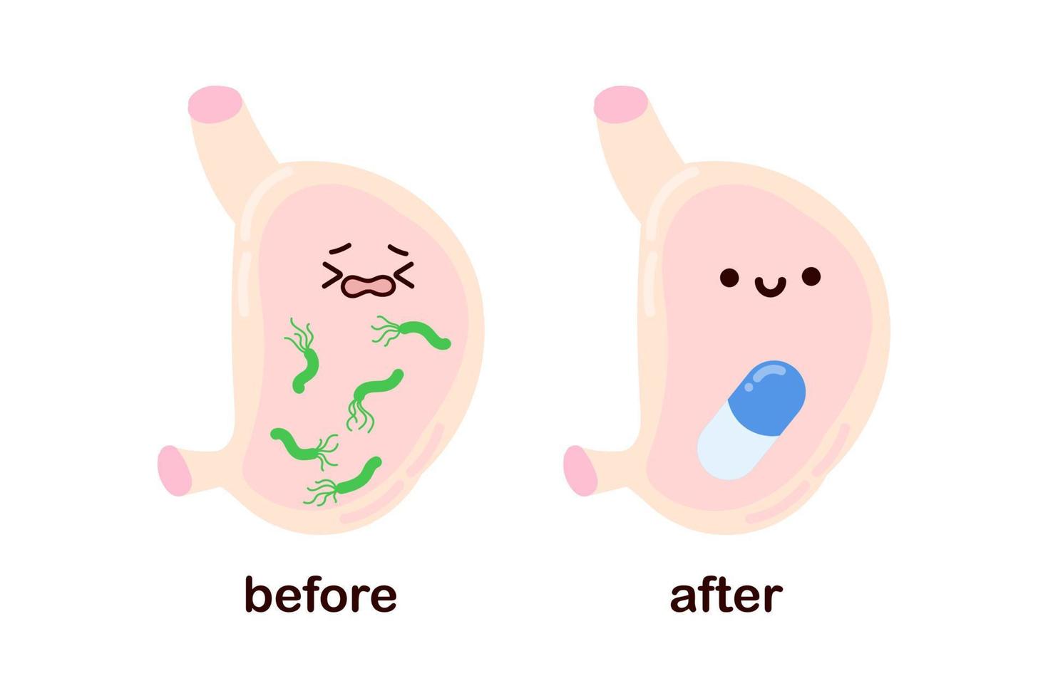 trauriger magen mit helicobacter pylori und fröhlicher gesunder magen nach der behandlung. Behandlung von Gastritis. süße kawaii menschliche organe. vektor