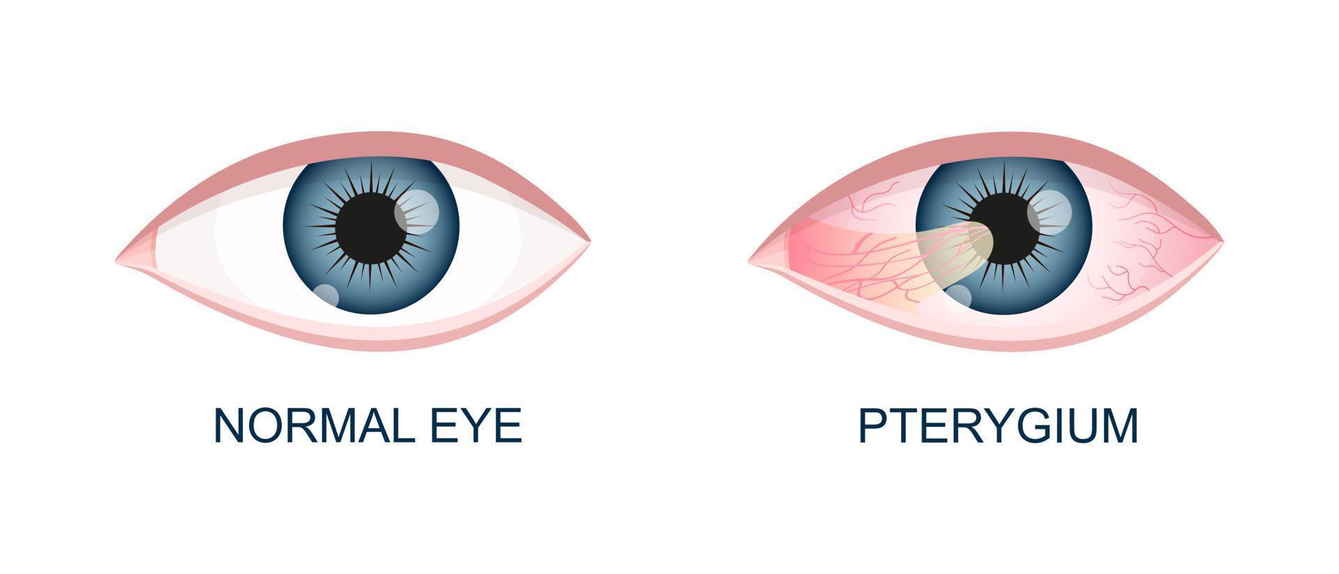 öga friska och med pterygium. konjunktival degeneration innan och efter kirurgi. öga sjukdom. mänsklig organ av syn med patologi vektor