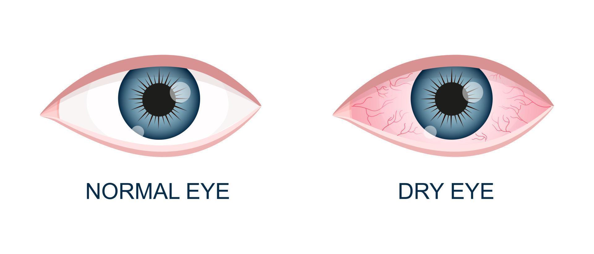 mänsklig öga friska och torr. vanligt och inflammerad blodskott eyeball med irritation och röd konjunktiva. symptom av keratit, allergi, konjunktivit, uveit vektor