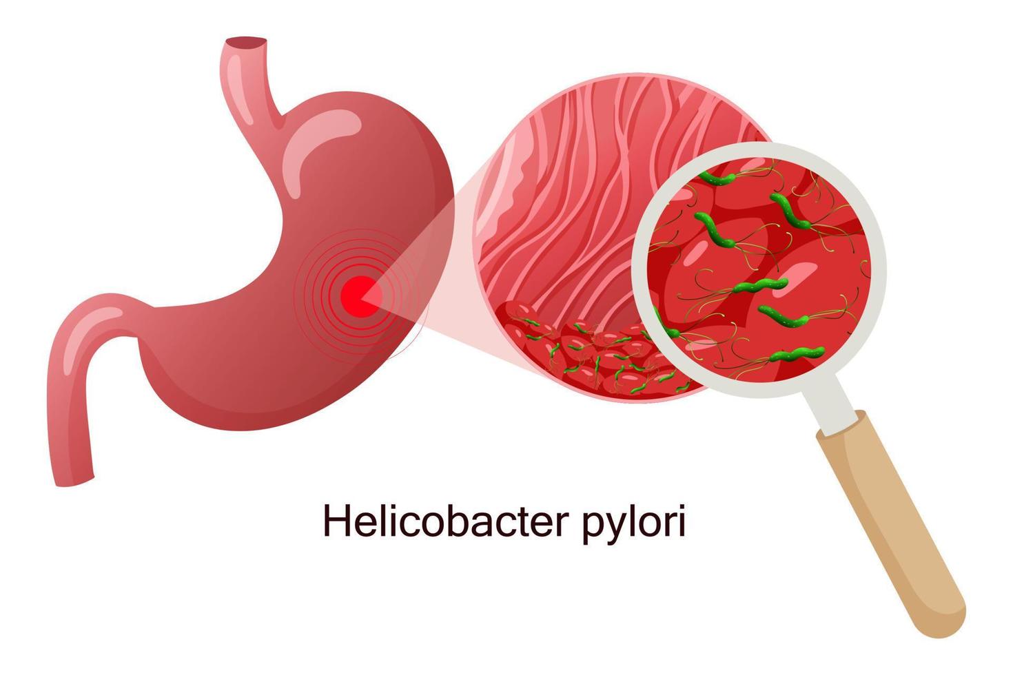 helicobacter pylori i mage slemhinna under förstorande glas. vektor illustration, tecknad serie stil, vit bakgrund