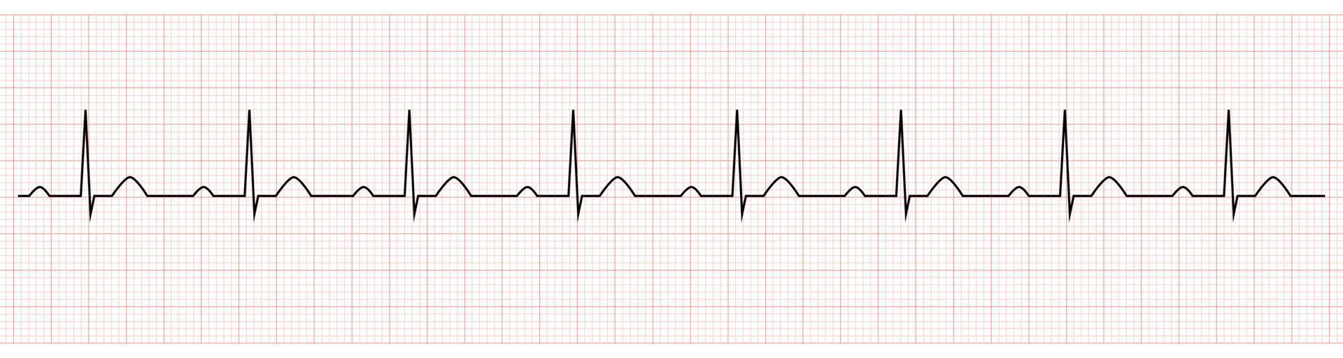 ekg som visar pr förlänga som är tecken av först grad AV blockera vektor