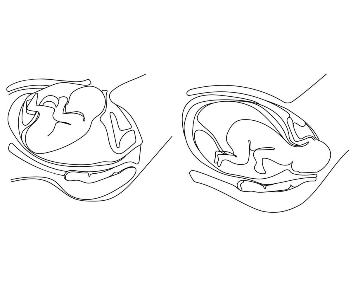 Geburt.vaginale Entbindung und C-Abschnitt-Symbole,Emblem,Poster-Design-Vorlage, Strichzeichnungen, Vektorgrafik, Symbole, Vektorgrafik.fetale Position innerhalb der Schwarz-Weiß-Zeichnung der Gebärmutterschleimhaut vektor