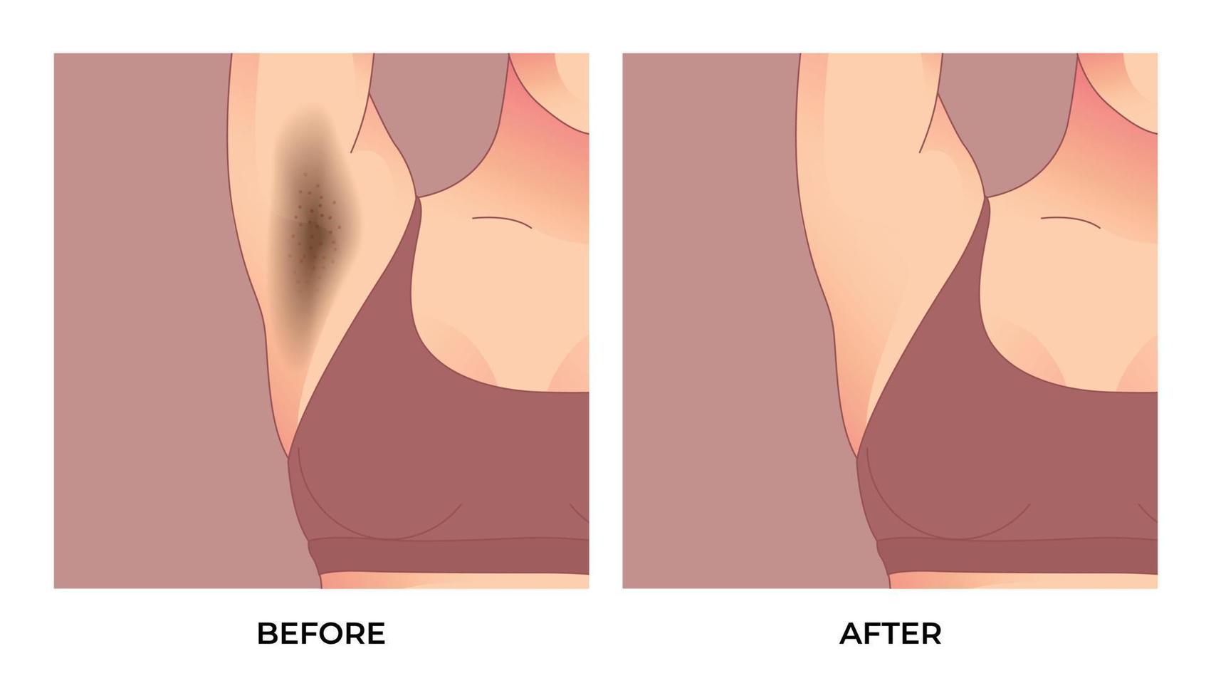 svart underarm, innan och efter hud vård kosmetologi armhålor epilering behandling. vektor