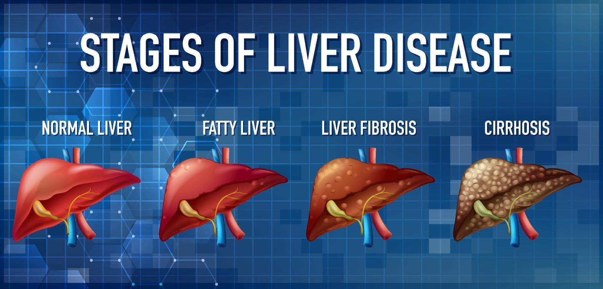 stadier av leversjukdom som leder till cirros vektor