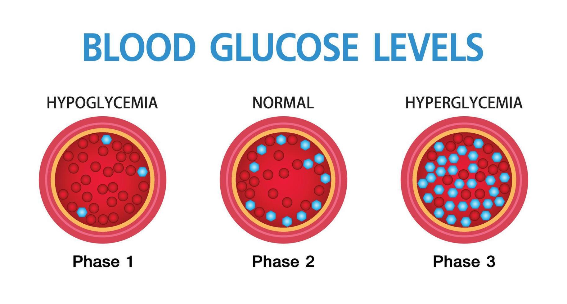 Hyperglykämie, hoher Blutzucker und Diabetes, Fettleibigkeit ist eine ernsthafte Erkrankung, Vektordesign. vektor