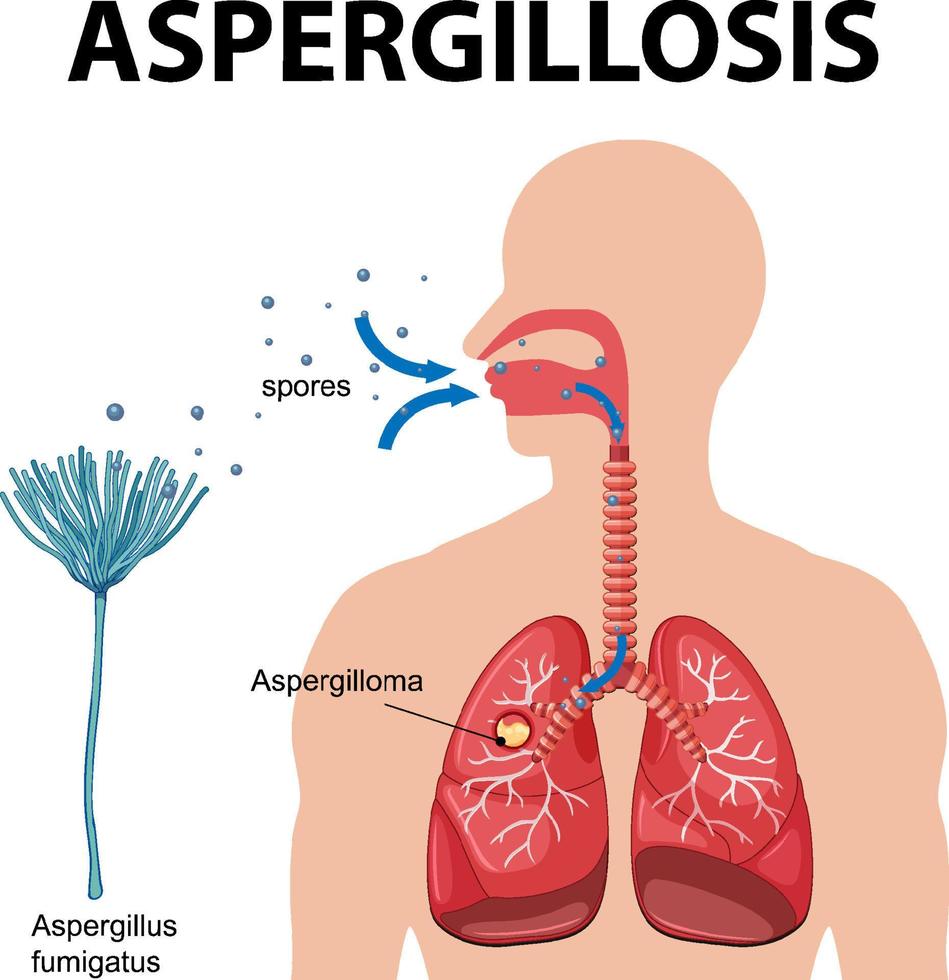 diagram som visar aspergillus-infektion vektor