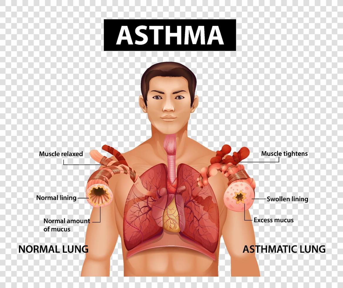 Diagramm, das Asthma auf transparentem Hintergrund zeigt vektor