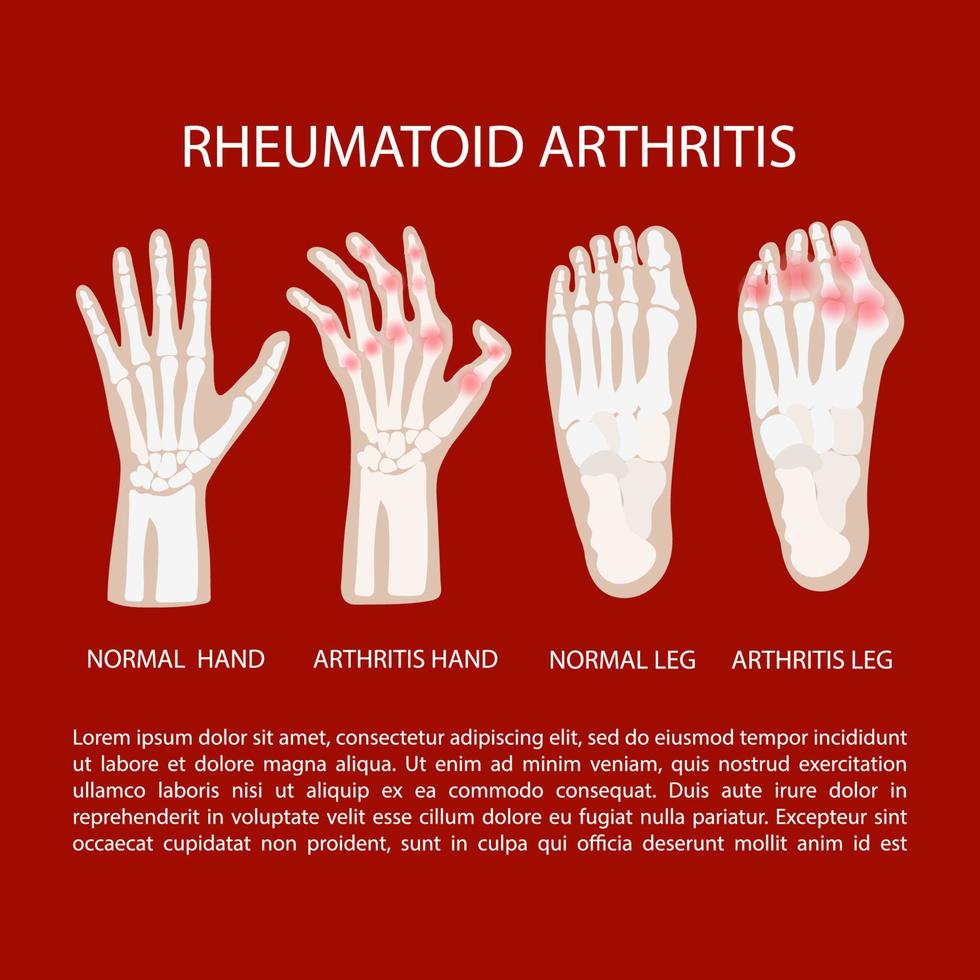 artrit ben hand reumatoid medicin utbildning vektor schema