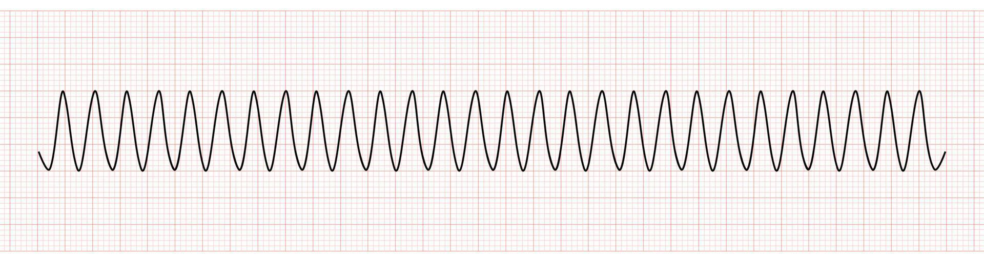 ekg Monitor zeigen ventrikulär Tachykardie oder vt vektor