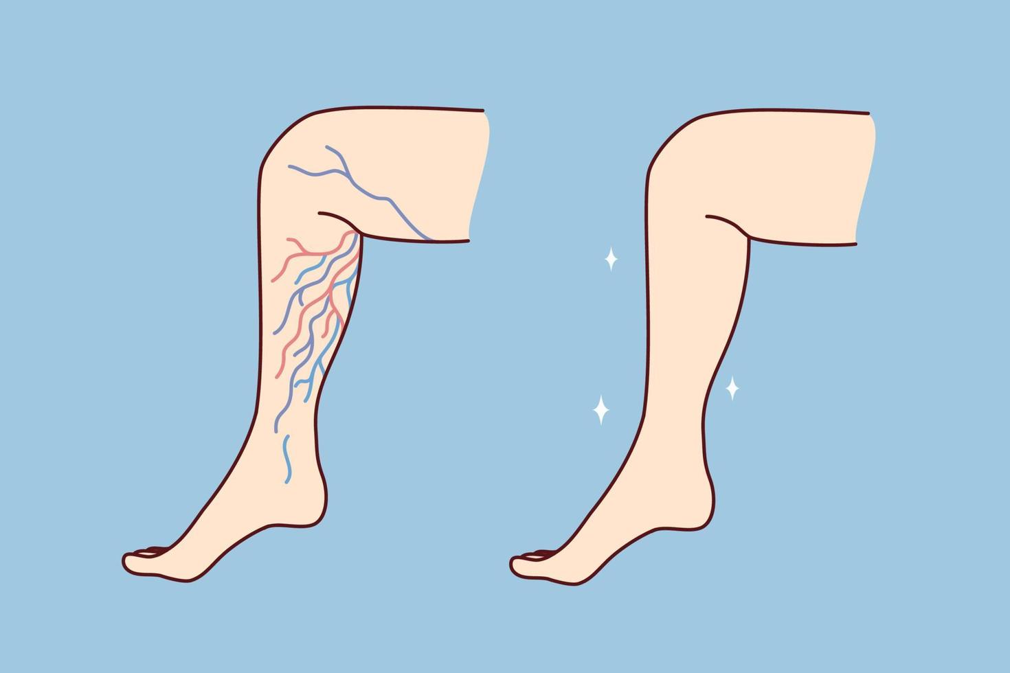 Nahansicht von ungesund und gesund Bein mit Krampfadern- Venen. geduldig leiden von Krampfadern. Gesundheitswesen und Medizin. Vektor Illustration.