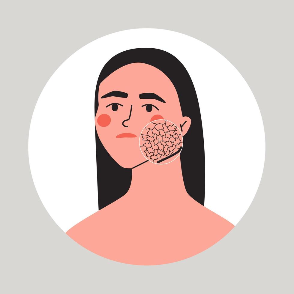 ung kvinna med torr ansiktsbehandling hud. zoom cirkel som visar problem med hud. hud vård och föryngring begrepp. vektor