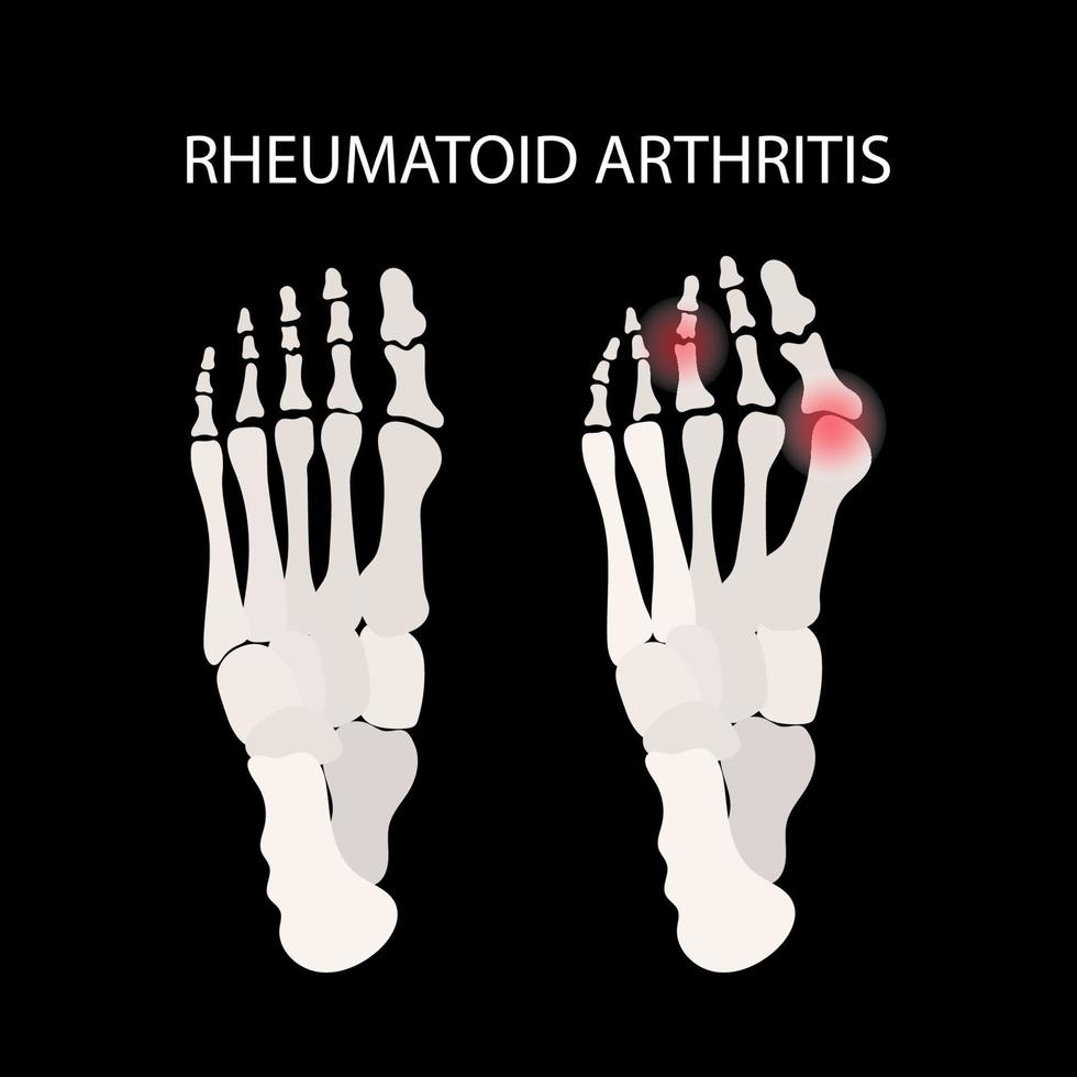 rheumatoide Arthritis Bein Medizin Bildung Vektor planen