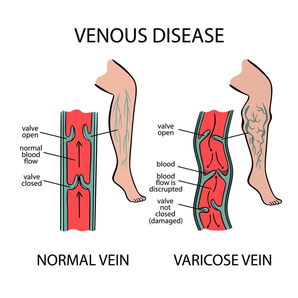 Krampfadern- Venen venös Krankheit von Mensch Medizin Bildung vektor