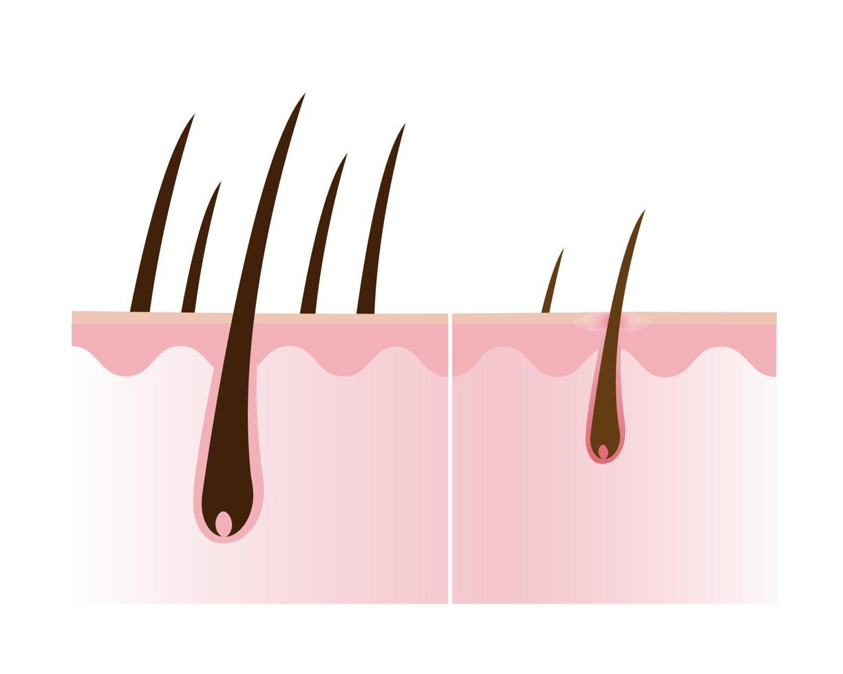 Vergleich von gesund und verlieren Haar mit Kopfhaut Schicht Vektor isoliert auf Weiß Hintergrund. Haar Dichte, Verlust, Alopezie, Kahlheit und unbehaart. Haar Anatomie Konzept Illustration.