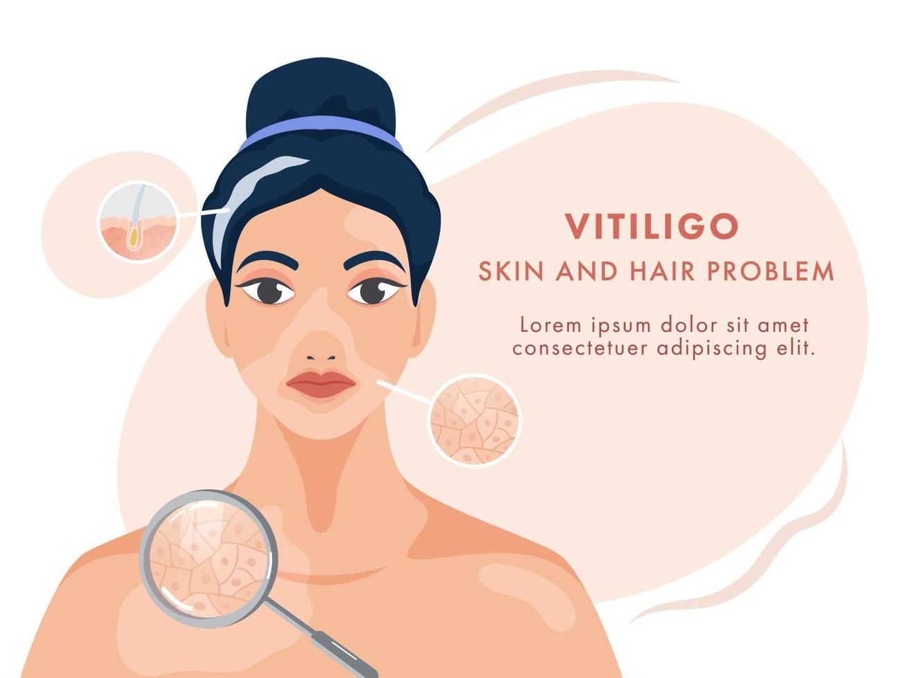 karaktär av ung kvinna som visar vitiligo hud och hår problem på vit bakgrund. vektor