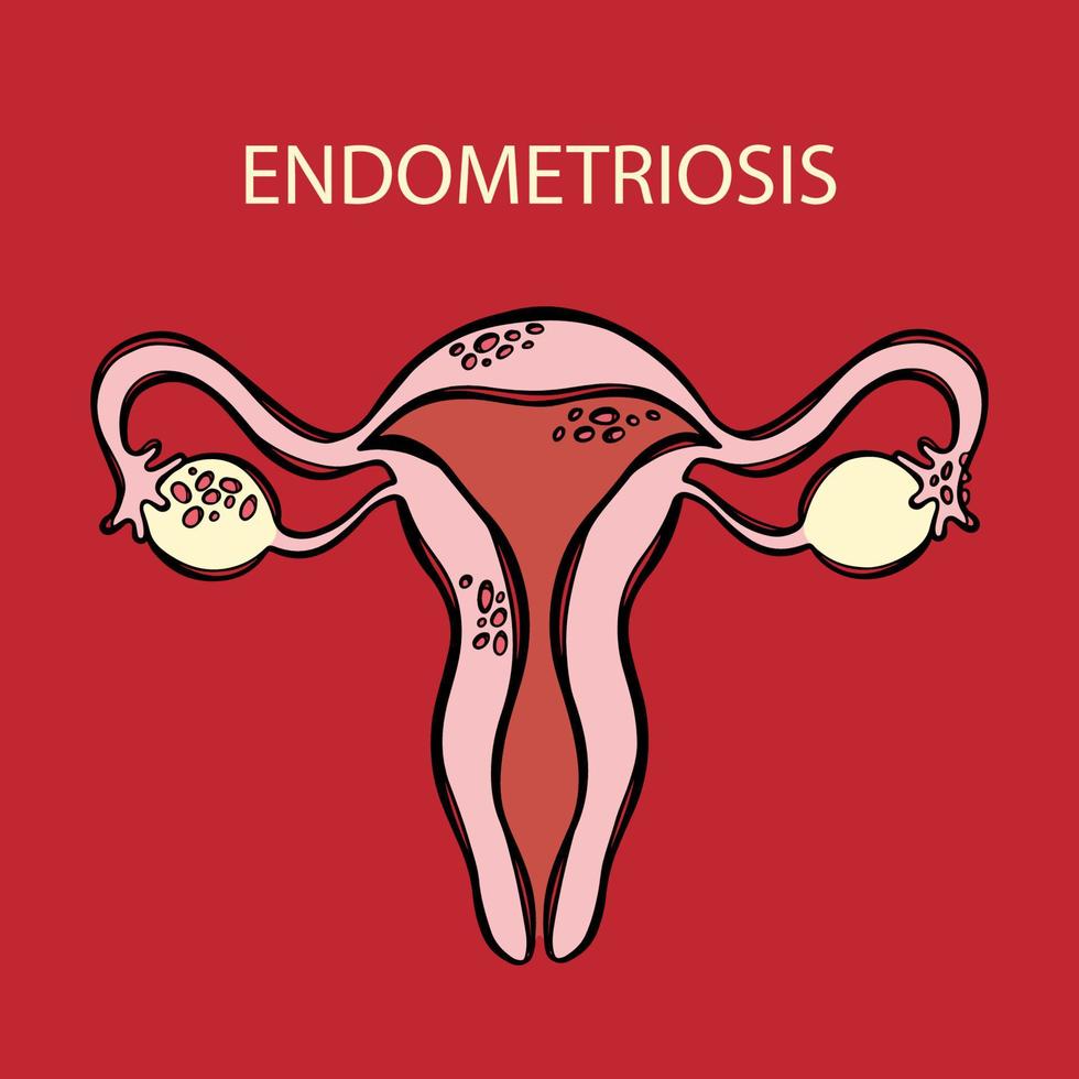 endometrios kvinna reproduktiv systemet medicin utbildning vektor