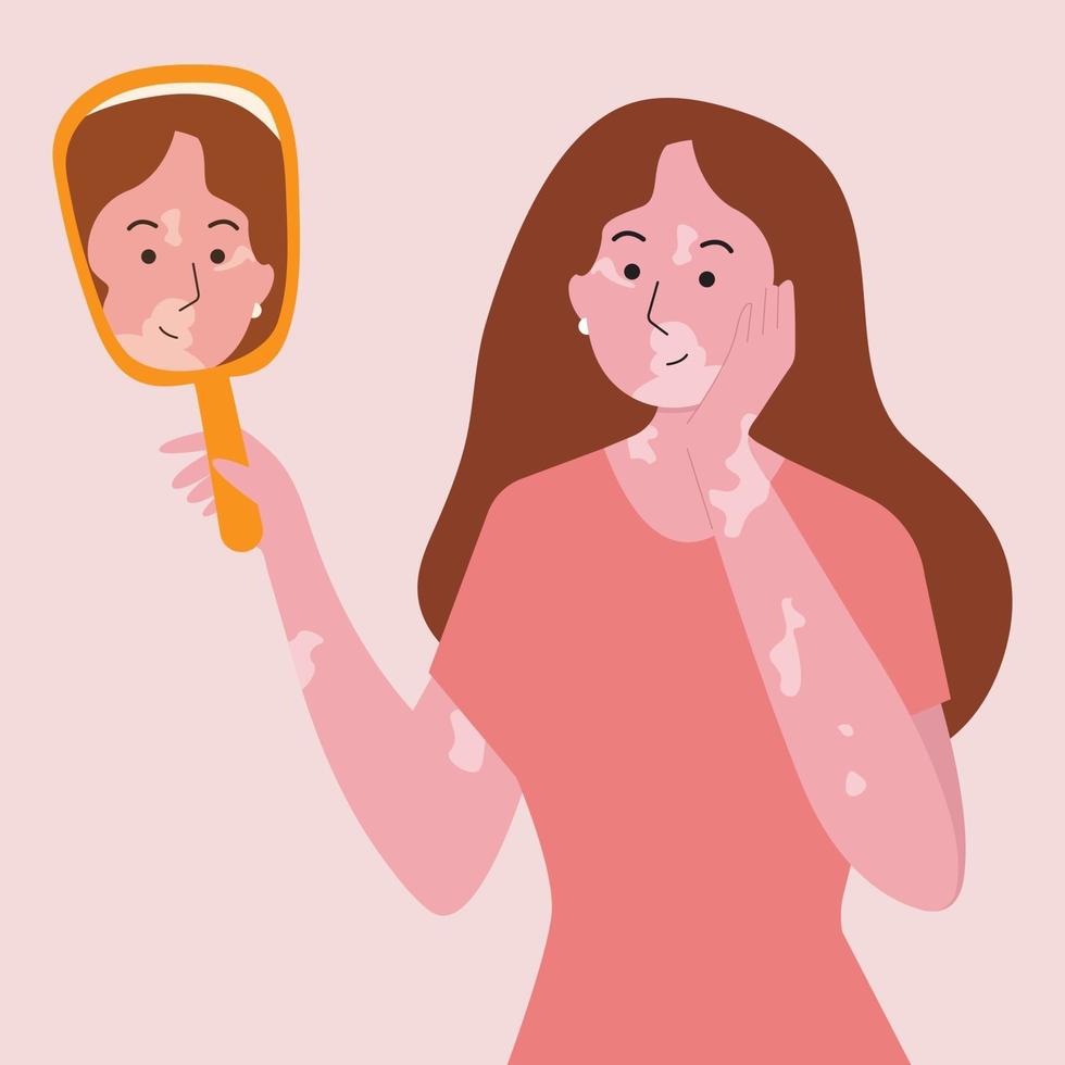 Die Frau mit Vetiligo schaut im Spiegel auf ihr Gesicht. vektor