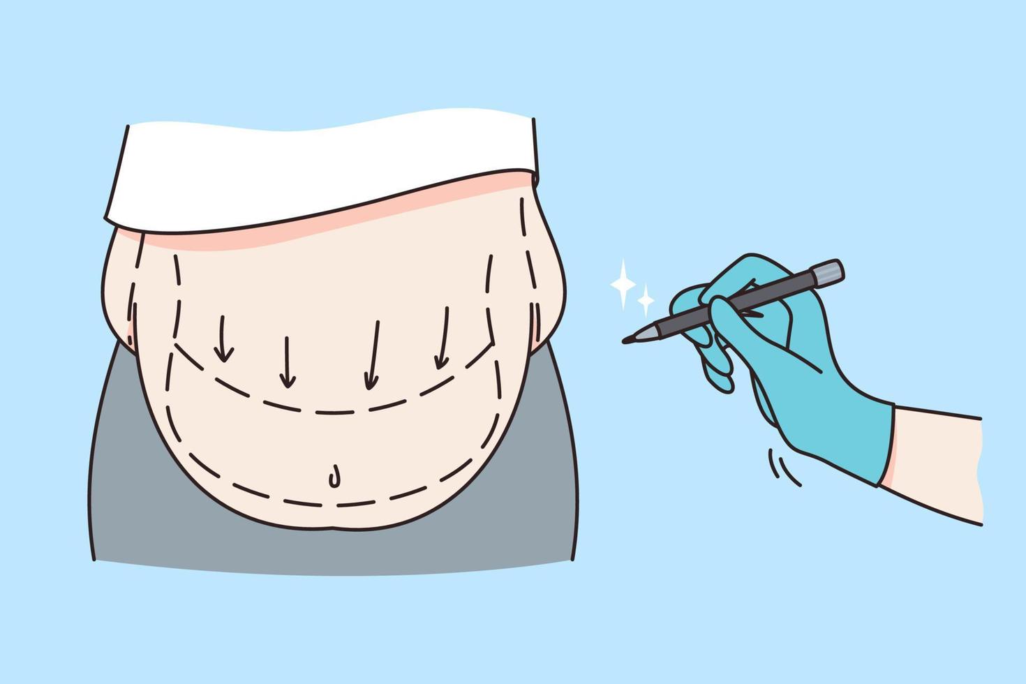 Körper Pflege und Fettabsaugung Konzept. Bauch von weiblich mit Übergewicht und Hand von Arzt Herstellung Anmerkungen von Chirurgie Betrieb Vektor Illustration