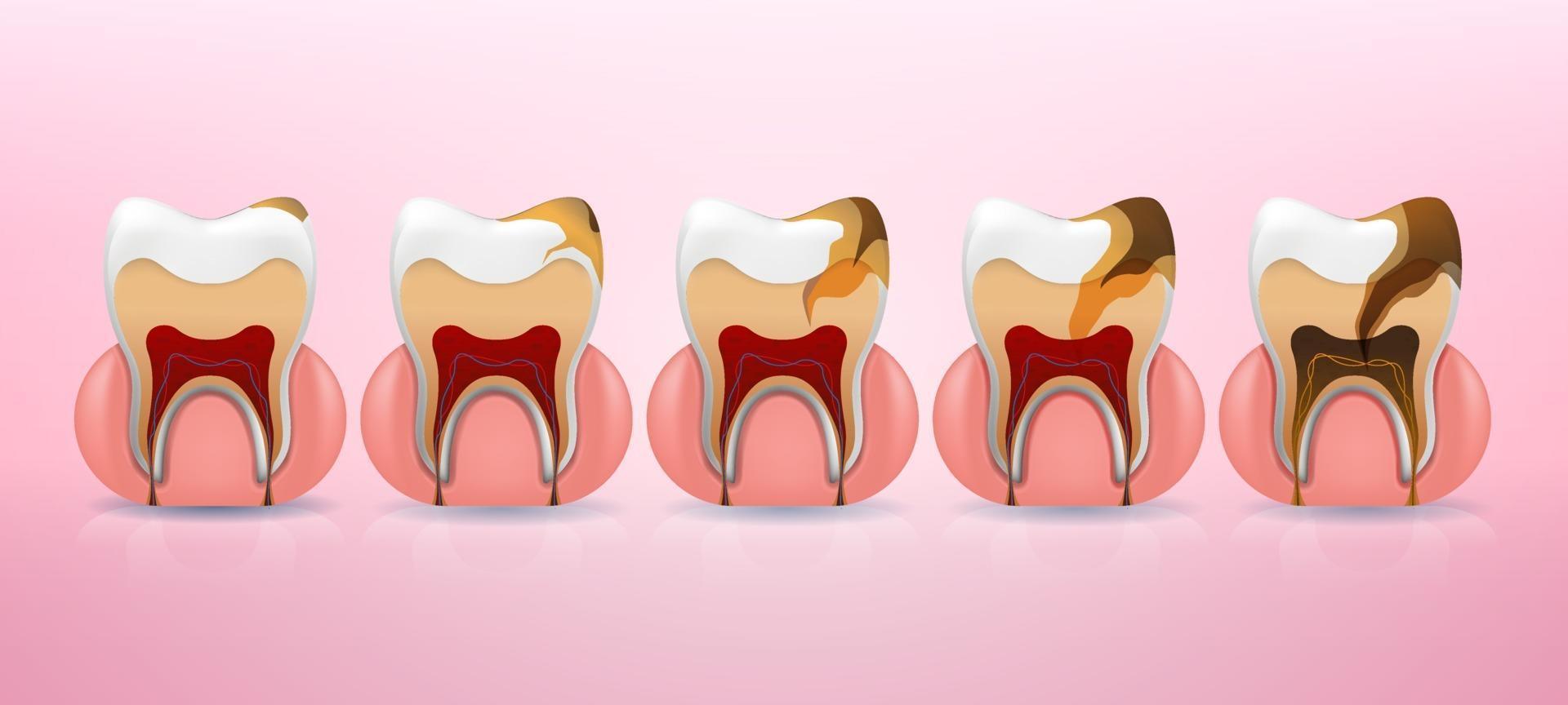 tandkariesstruktur och fullständiga placeringssteg i realistisk stil. fläck, emaljkaries, dentil, pulpit, periodontit. vektor illustration 3d.