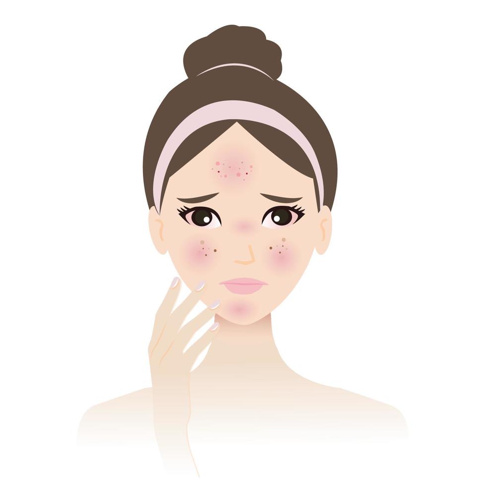 das Haut Allergie auf Frau Gesicht Vektor isoliert auf Weiß Hintergrund. das allergisch Reaktion Haut wird irritiert, Ausschlag, Juckreiz, Verbrennung, Rötung, Beulen, Nesselsucht und Schwellung. Haut Problem Konzept.