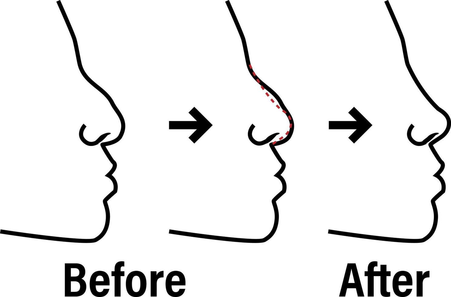 näsplastik innan och efter de procedur infografik. näsa plast kirurgi vektor översikt begrepp medicinsk illustration
