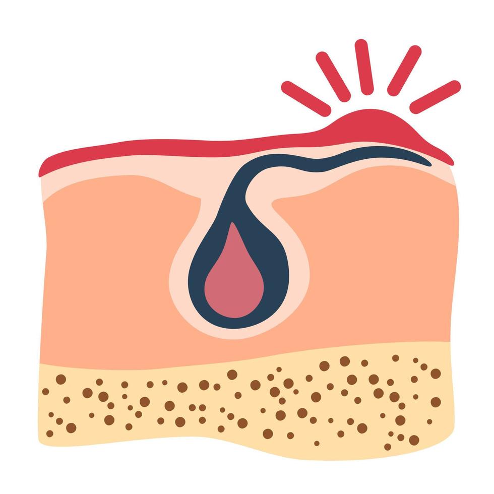 ingrown hår. inflammation, hud problem. anatomi infographics av hår. vektor illustration isolerat på de vit bakgrund.