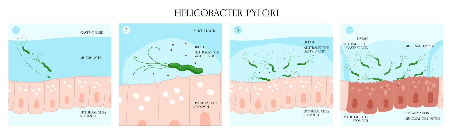 Helicobacter Pylori Infektion Prozess im Bauch Schleimhaut Schicht Infografik vektor