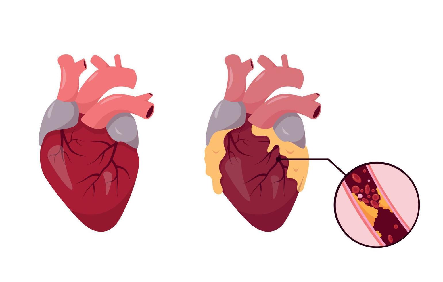 gesund und ungesund Mensch Herz. ischämisch Krankheit. verstopft Koronar Arterie mit Atherosklerose. Vektor Illustration auf Weiß Hintergrund.