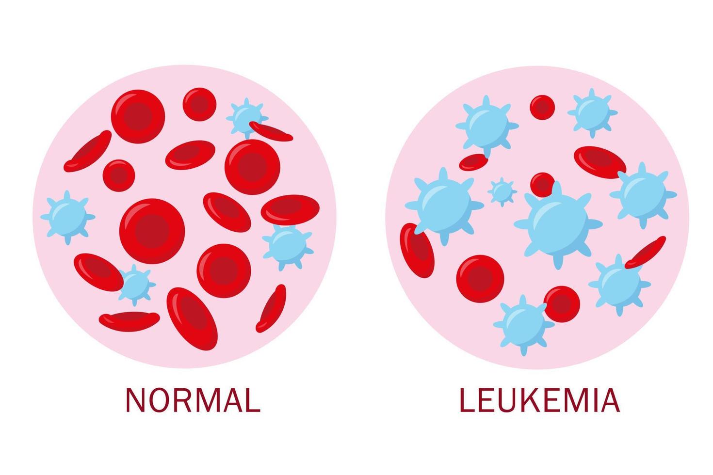 normal Blut und Leukämie Blut zum medizinisch Konzept. Blut Analyse oder Leukämie Prüfung Banner. Vektor Illustration.