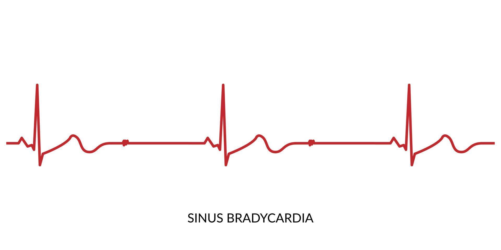 ecg hjärtslag linje. elektrokardiogram vektor illustration. sinus bradykardi