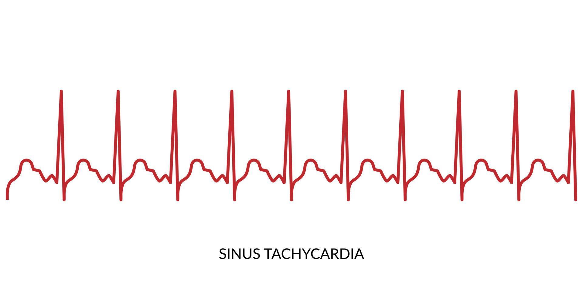 EKG Herzschlag Linie. Elektrokardiogramm Vektor Illustration. Sinus Tachykardie