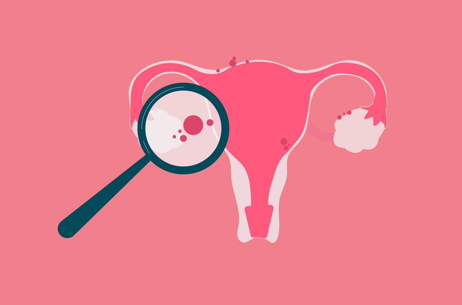 Endometriose-Konzeptillustration für medizinischen Inhalt oder Bildungszweck. vektor