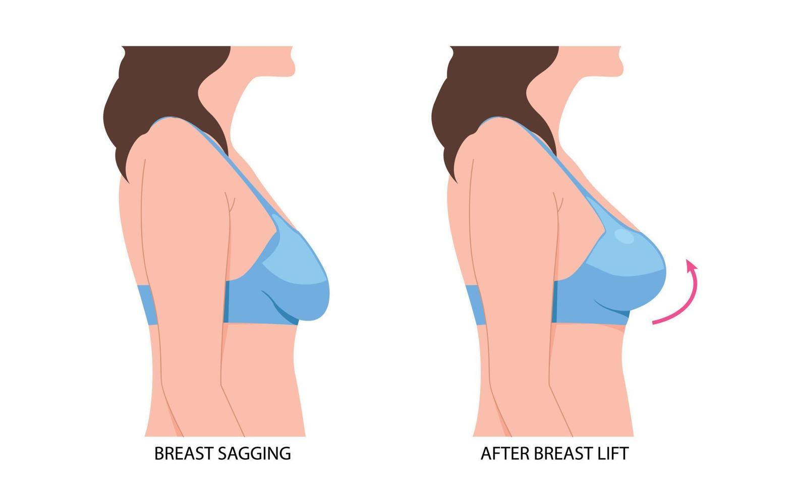 Brust Fett Transfer Aufzug asymmetrisch Nippel durchhängen verjüngen Chirurgie Implantation klein Größe sinken vektor