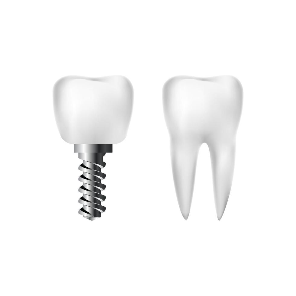 realistisch gesund Weiß Zahn und implantieren mit schrauben. Zahnheilkunde und Zahnarzt Pflege. Vektor