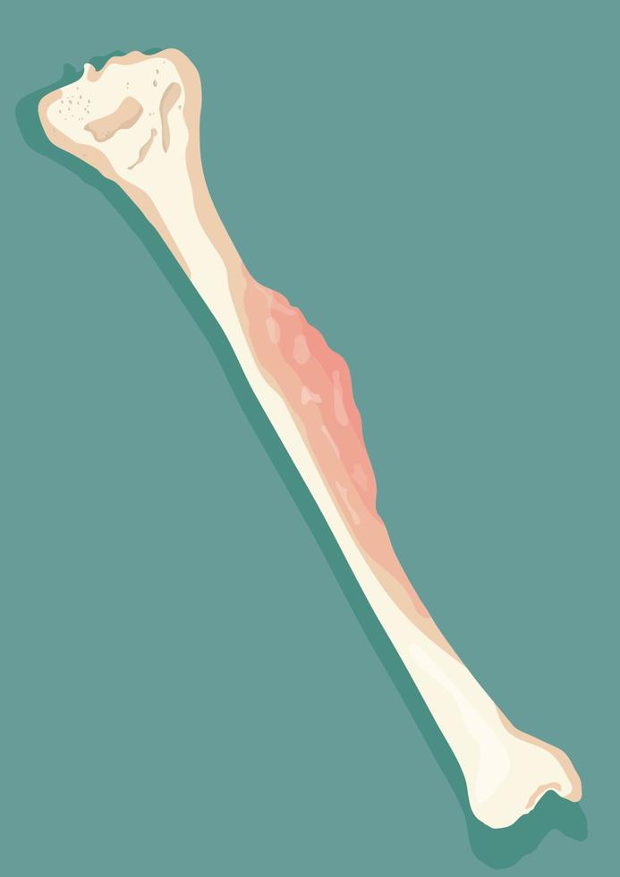 Darstellung von Knochen Krebs - - Vektor Illustration