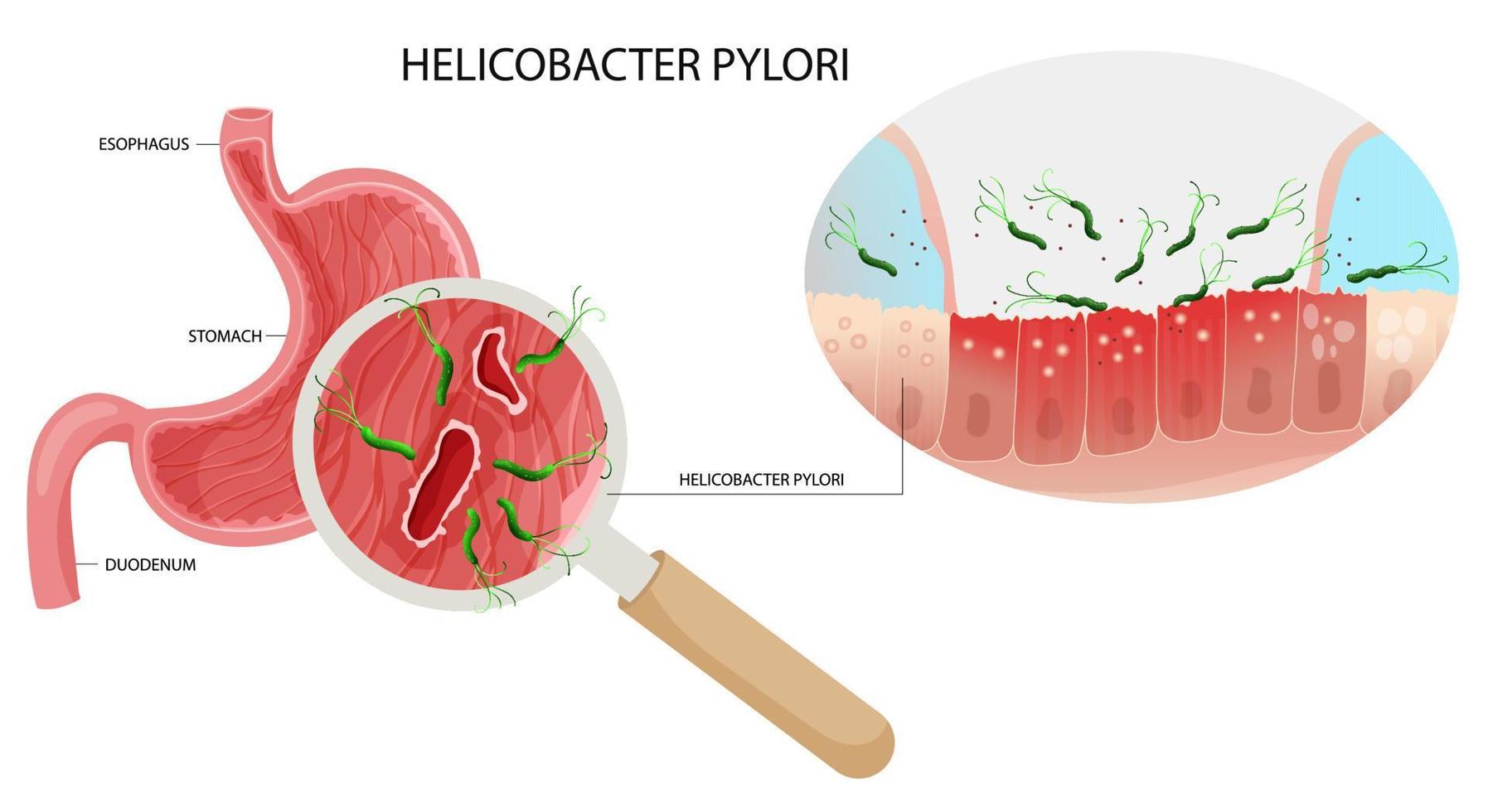 Helicobacter Pylori Infektion im Bauch Geschwür unter Vergrößerung. vektor