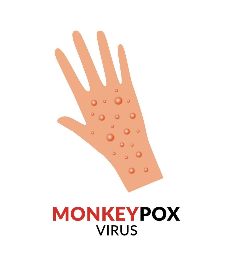 Hand mit Affenpocken eben Design Vektor Illustration. Krankheit Verbreitung aufmerksam. Ausbruch Virus Infektionen