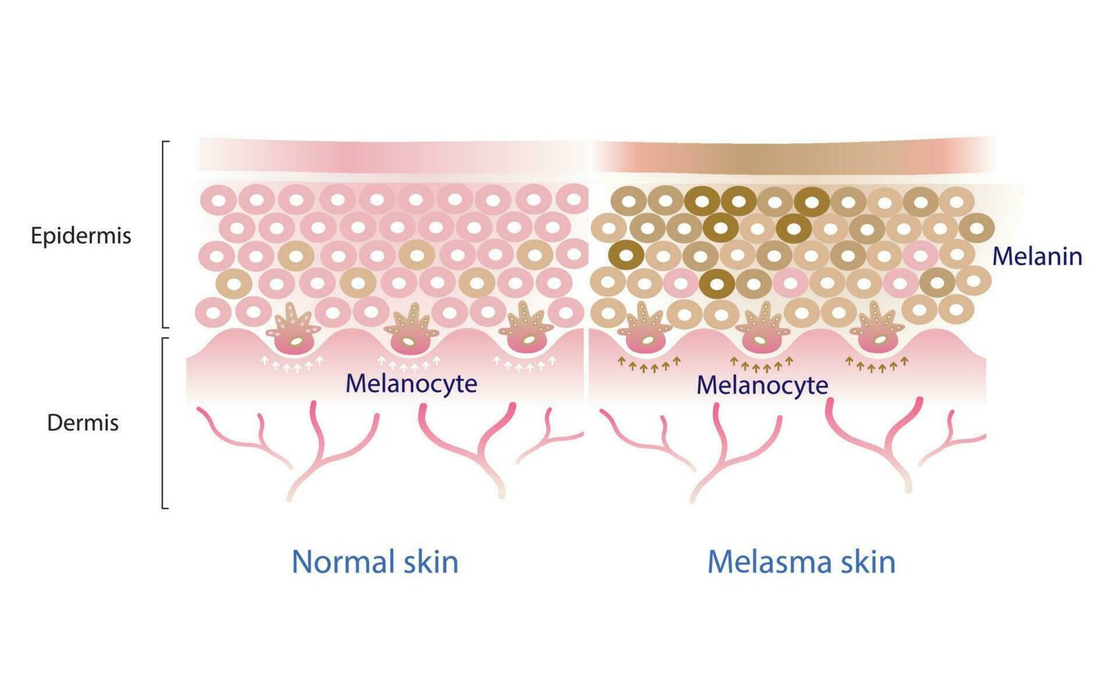 normal Haut Schicht und Melasma Haut Schicht Vektor, Melanozyt, Melanin, Melanogenese Vektor auf Weiß Hintergrund.