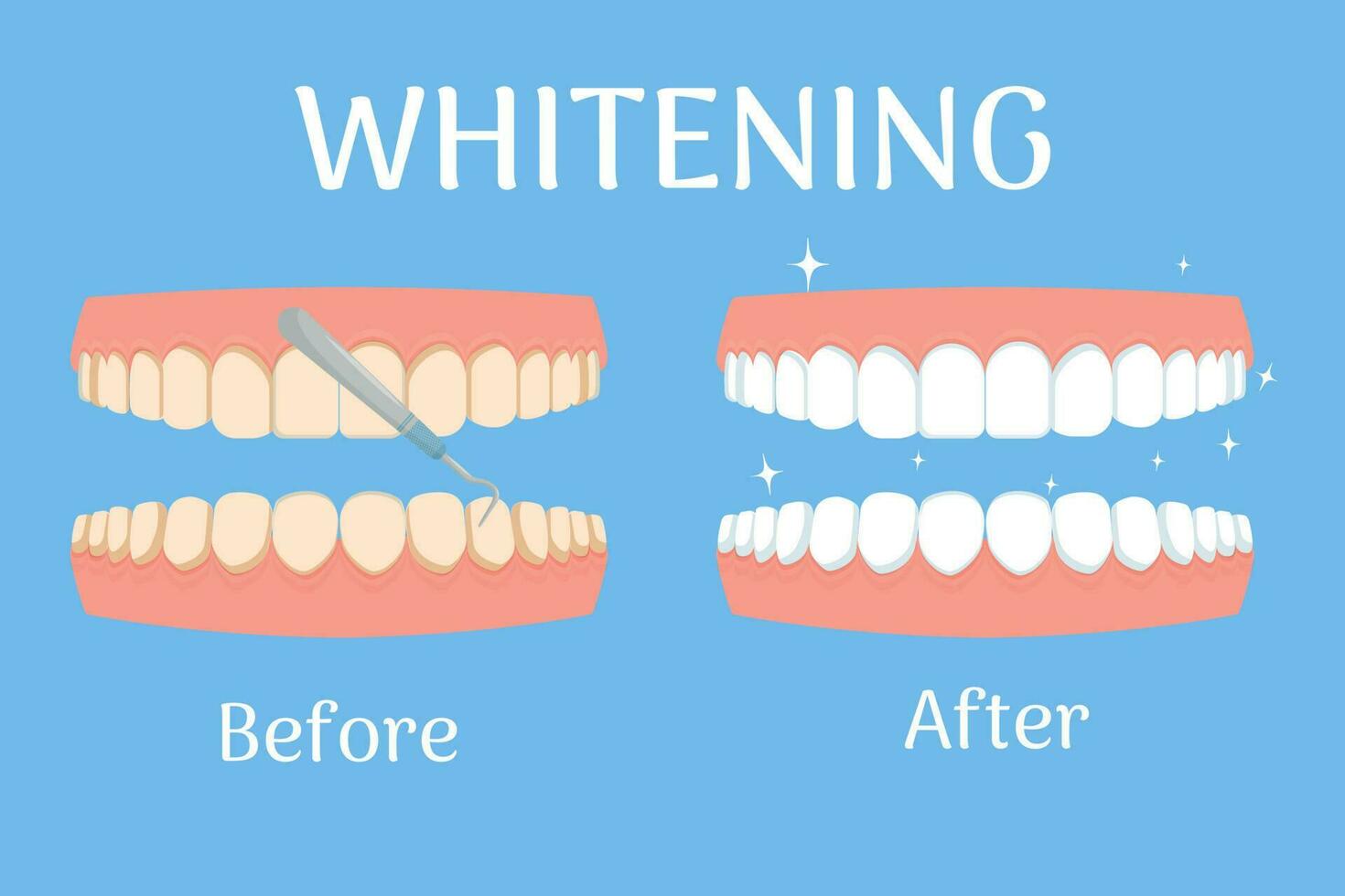 Zähne mit Gummi, Text Bleaching isoliert auf Weiß Hintergrund. Dental Pflege, Stomatologie Konzept im eben Stil. Vektor Illustration