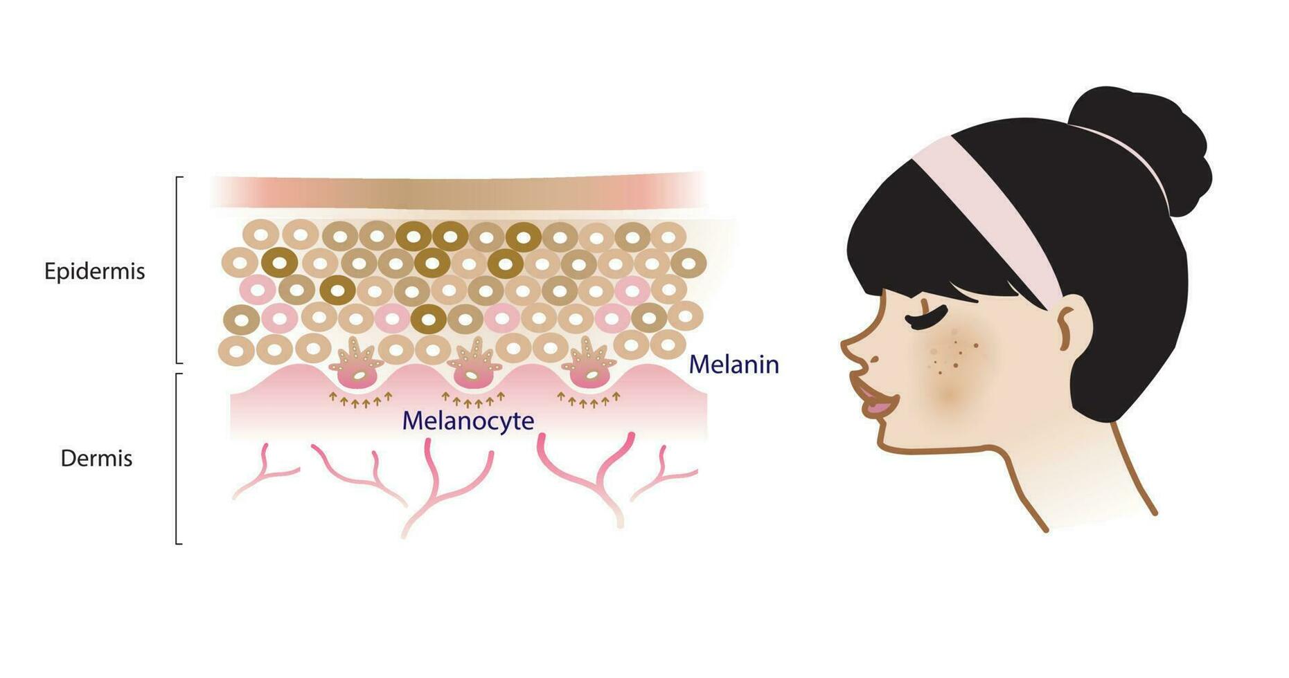 de mekanism av melasma hud vektor på vit bakgrund. infographic illustration av kvinna ansikte och hud lager. skönhet hud vård begrepp illustration.