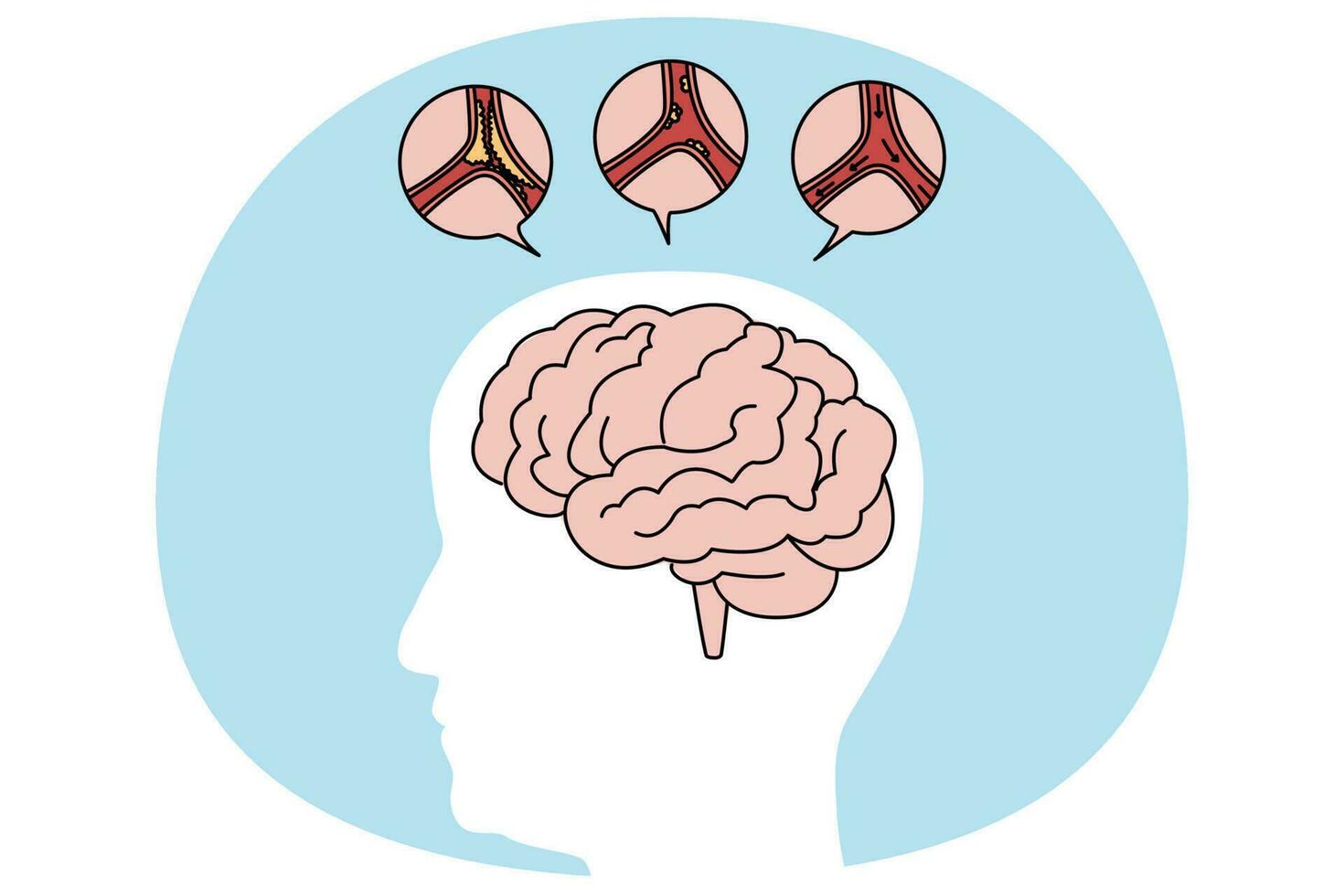 medizinisch Illustration von Mensch Gehirn Schlaganfall vektor