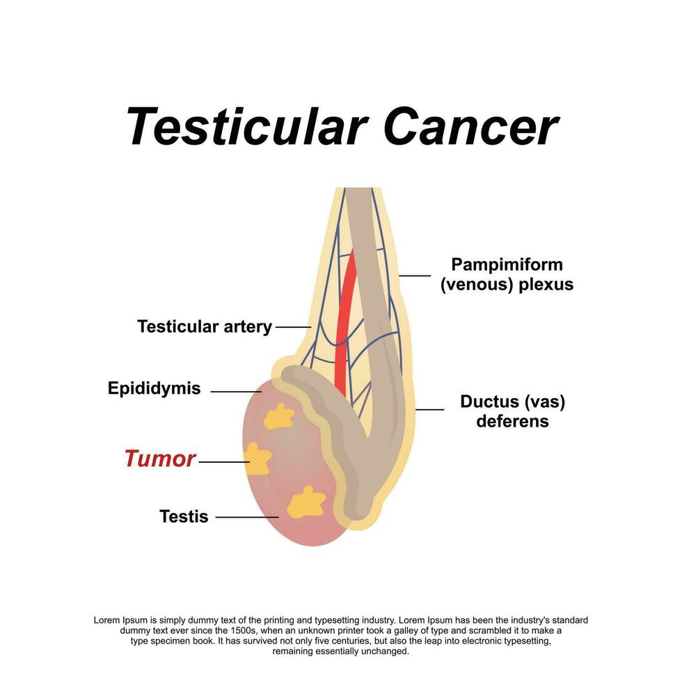 ein männlich Anatomie von Hoden Krebs vektor