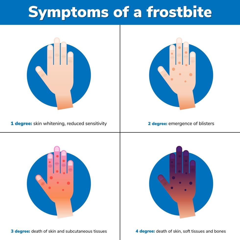 simptoms of a frostbite 4 medicinska stadier infografiska vektor